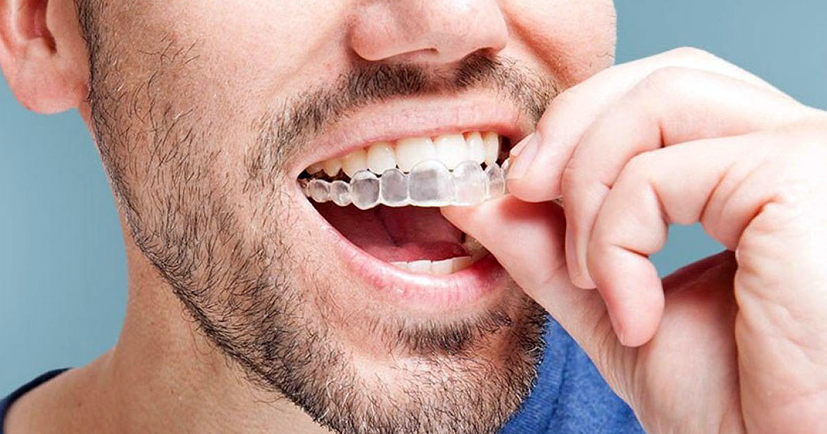 Saiba a resposta a estas 7 questões sobre Invisalign