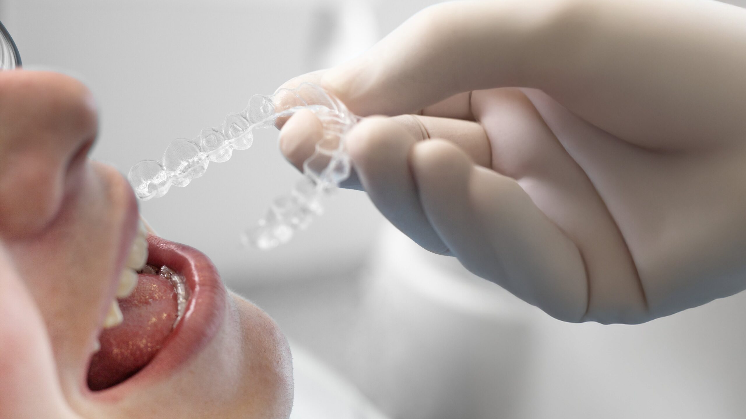 Alinhadores invisíveis: como corrigir os dentes sem aparelhos metálicos?